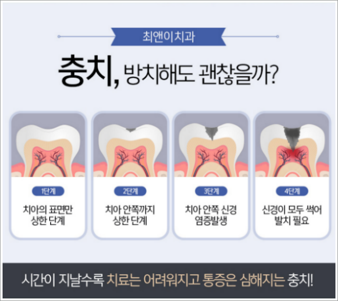 치과 레진 비용 찾아보고 계신다면 관련 이미지 3