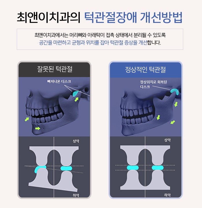 턱관절장애 미세하더라도 관련 이미지 4