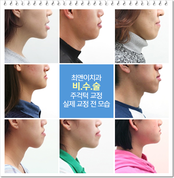 비수술주걱턱교정비용 과하지 않도록 관련 이미지 2