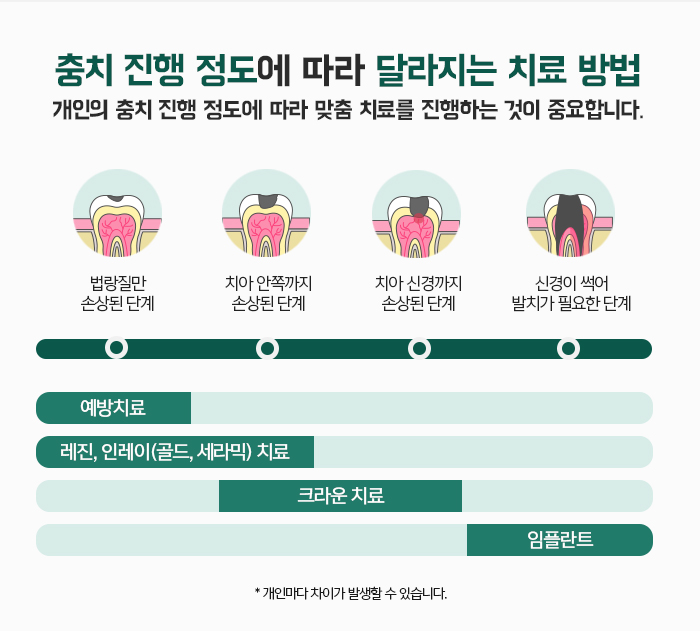 자연치아를 보존하기 위한 충치치료 방법 관련 이미지 6
