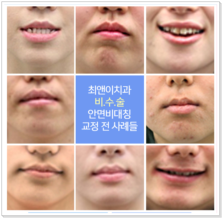 얼굴비대칭교정 비틀어져 보일 경우 관련 이미지 8