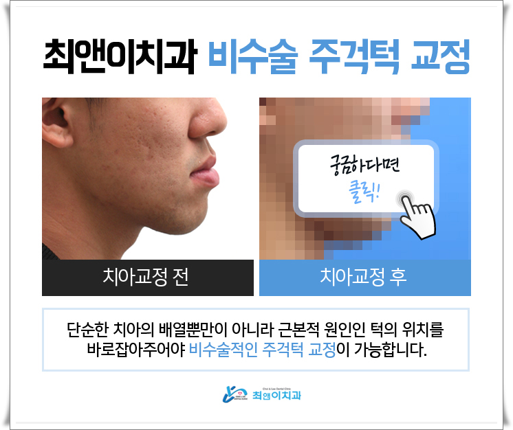 비수술주걱턱교정 힘들지 않고자 하려면 관련 이미지 5