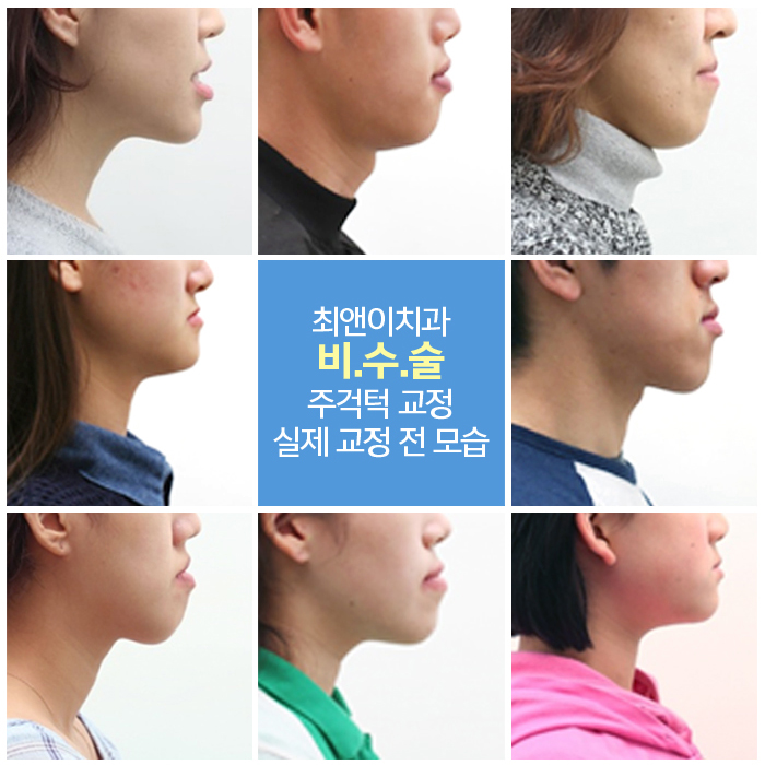 주걱턱치아교정 달라지고 싶으면 관련 이미지 3