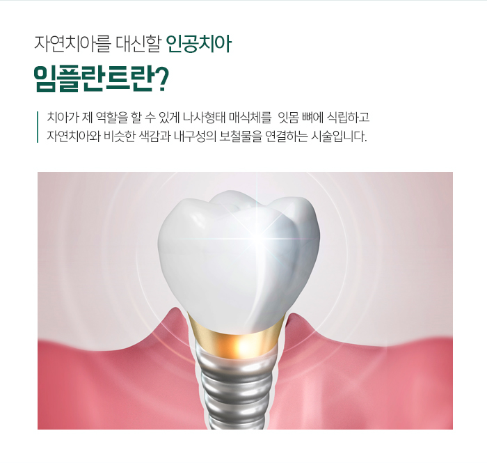 치아를 상실했을 때, 기능을 회복시켜주는 임플란트 관련 이미지 4