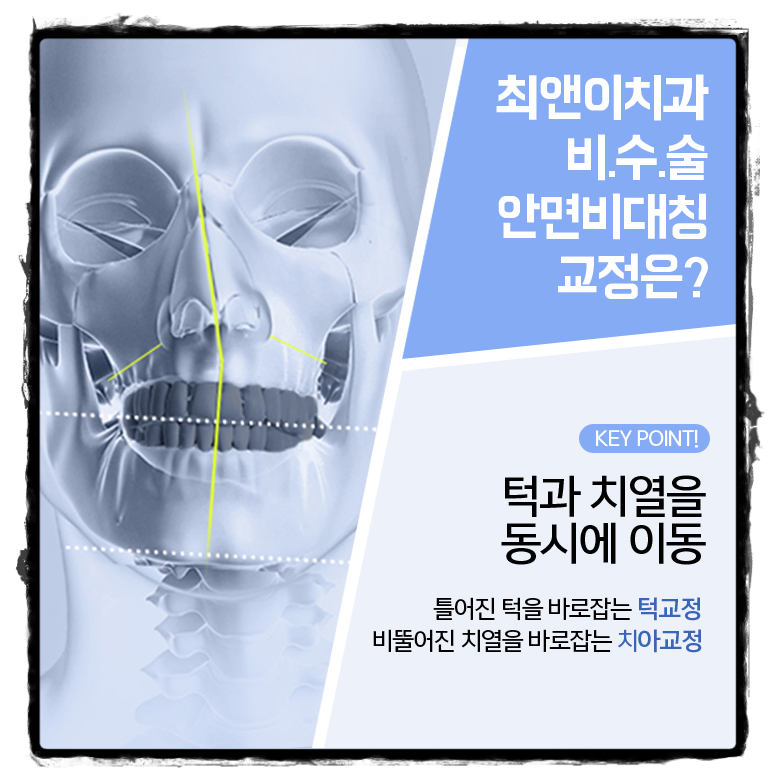 턱비대칭교정 알맞은 모습으로 바꾸자 관련 이미지 8