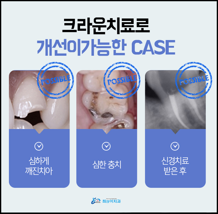 치아크라운가격 늦지 않도록 관련 이미지 9