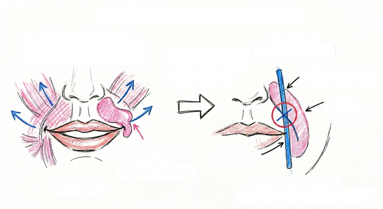 If You’re Worried About Side Effects of Nasolabial Fold Procedures, Such as Cheek Dents or Nodules - Larian Cheongdam Clinic image 2