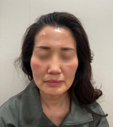 청담 피부과 스컬트라로 부모님 효도시술 했어요(효과 결절 부작용/전후사진 비교) 관련 이미지 3