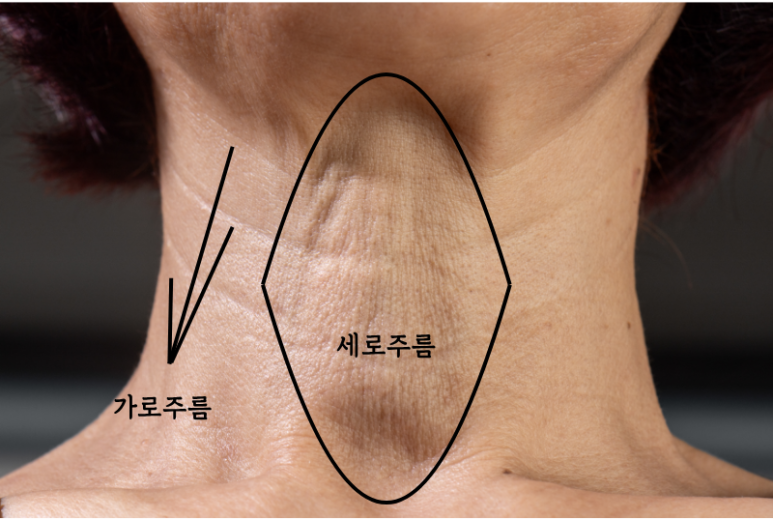 청담 피부과 목주름 시술, 어떻게 개선할 수 있을까? 관련 이미지 1