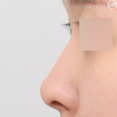 뭉툭한 복코성형, 에이비성형외과 케이스리뷰 관련 이미지 6
