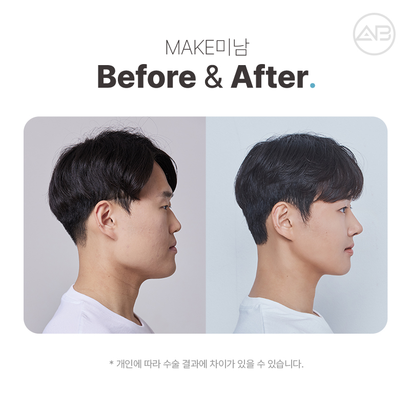 에이비성형외과 맥미남(MAKE미남)9회 - 민원유발내남자 짧은코수술, 매부리코수술 알아보기! 관련 이미지 6