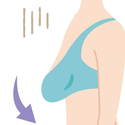 [Breast Augmentation] I’m Curious About the Newly Released Mentor Implant - Mentor Boost - image 2