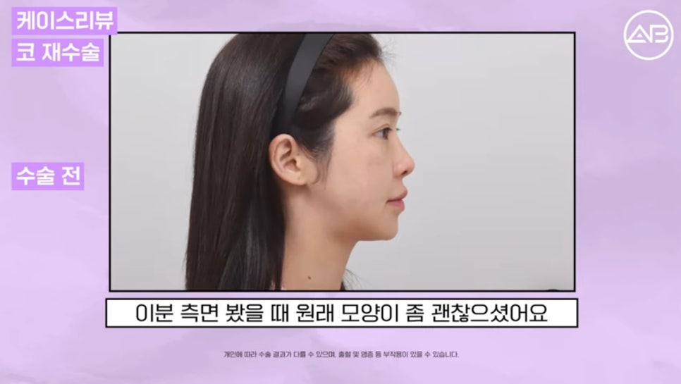 #AB Plastic Surgery #AB TV #Case Review #Nose Surgery #Revision Rhinoplasty image 2