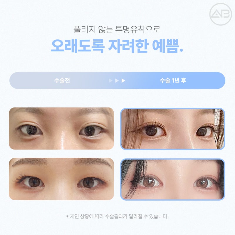 처음부터 예뻤던 것처럼, 에이비성형외과 자려한투명유착 관련 이미지 7
