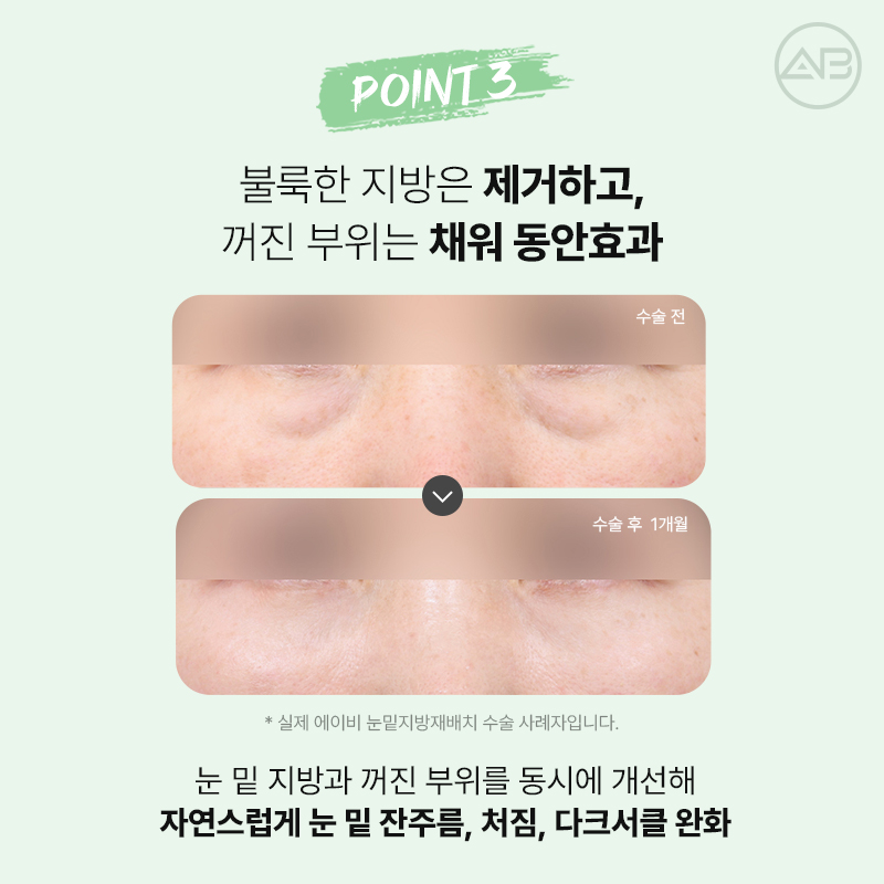 에이비성형외과 눈밑지방재배치 하안검 수술 전후 다크서클 개선과 에이빛주사 이벤트 관련 이미지 6