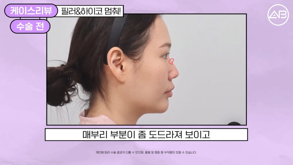 #에이비성형외과#에이비tv#케이스리뷰#코성형 관련 이미지 2