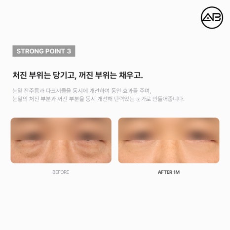 AB Plastic Surgery Under-Eye Fat Repositioning: Effects on Dark Circles and Hollow Under-Eyes, Before-and-After Results, and Side Effects image 6