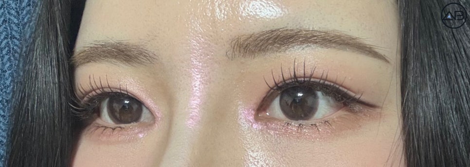 비절개눈매교정+앞트임+뒤트임+밑트임 성형케이스 리뷰 관련 이미지 6