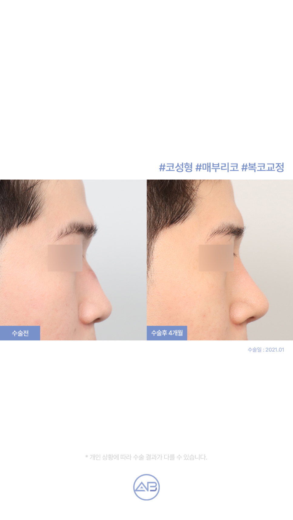 에이비성형외과 자려한코성형 수술전후 관련 이미지 1