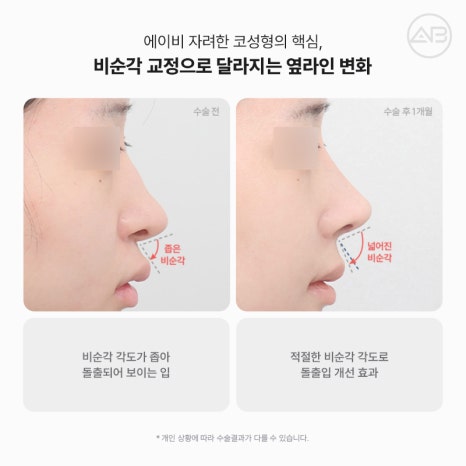 자려한비주라인코성형 AB성형외과에서 완성해보세요 관련 이미지 9