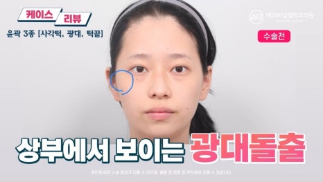 #에이비성형외과#에이비tv#케이스리뷰#윤곽3종수술 관련 이미지 1