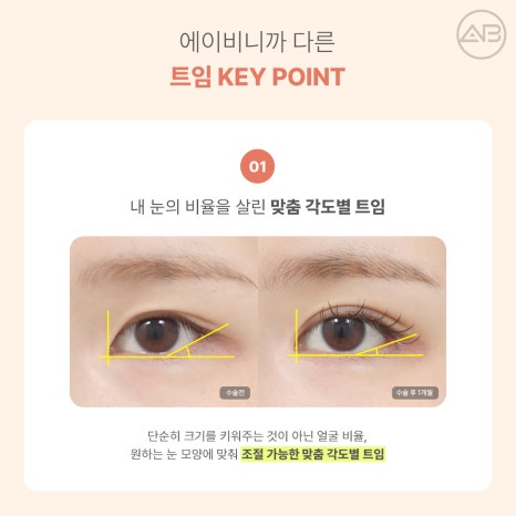 AB Plastic Surgery Eye Corner Surgery: Types and Reviews of Epicanthoplasty, Canthoplasty, and Lower Canthoplasty image 7