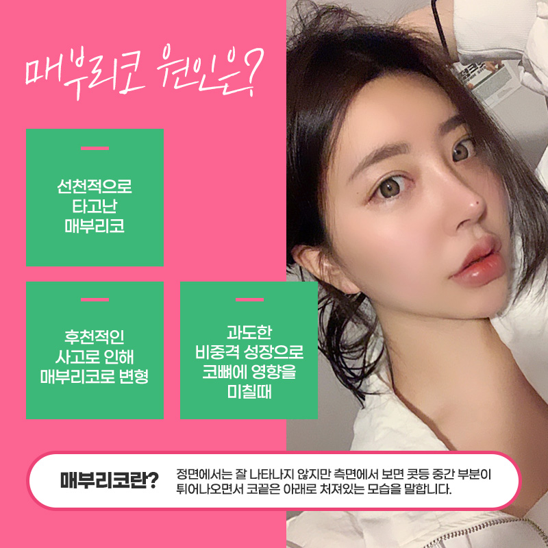 매부리코교정 에이비에서 자연스럽게 관련 이미지 2