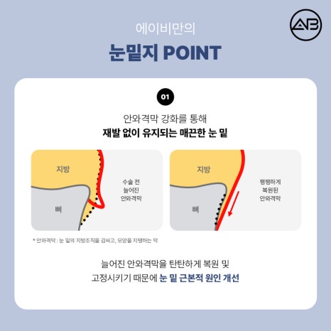에이비성형외과의원 눈밑지방재배치 눈밑지 수술 방법 후기 관련 이미지 5