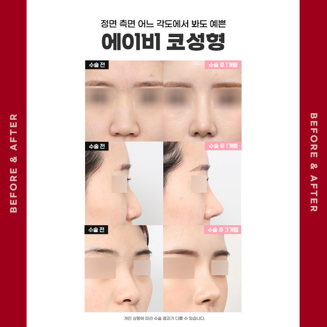코수술후기 많은 에이비성형외과 관련 이미지 5
