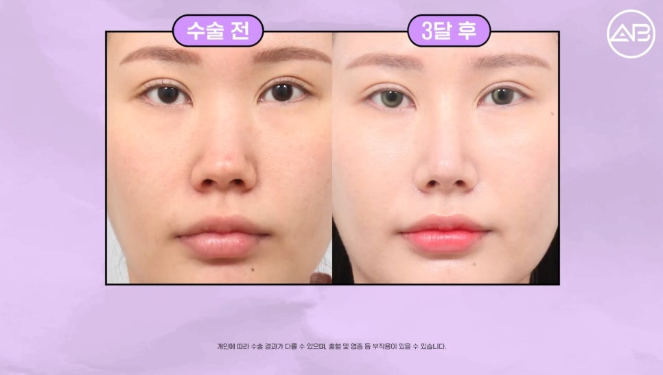 #에이비성형외과#에이비tv#케이스리뷰#코성형 관련 이미지 5