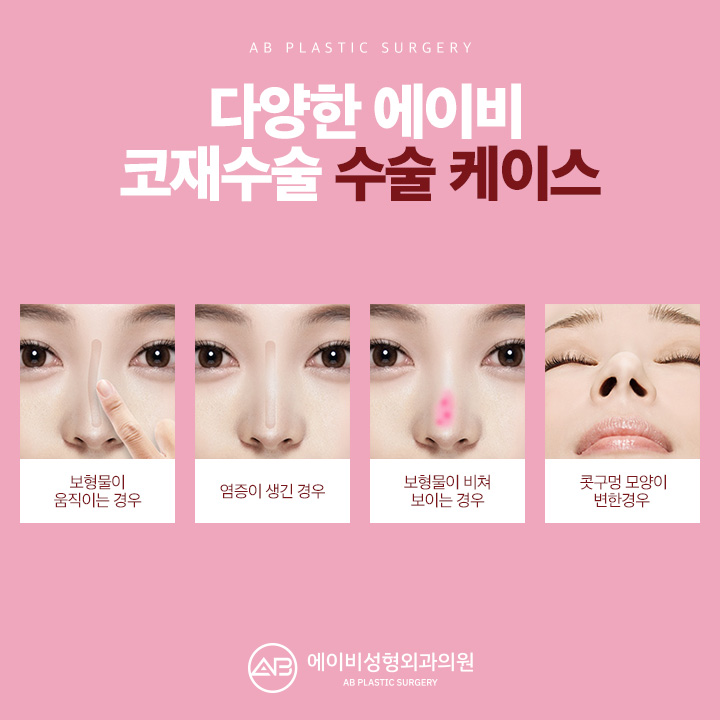 Reducing Worries About Side Effects After Revision Rhinoplasty image 5