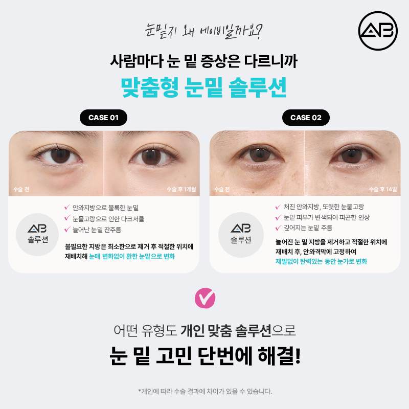에이비성형외과의원 눈밑지방재배치 눈밑지 수술 방법 후기 관련 이미지 4