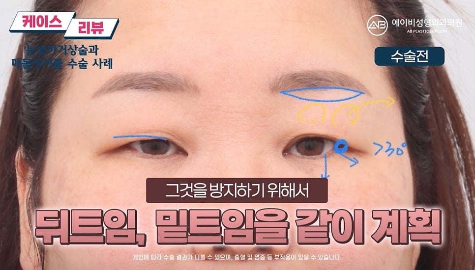#에이비성형외과#에이비tv#케이스리뷰#중년눈성형 관련 이미지 6