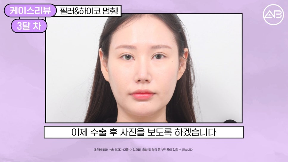 #에이비성형외과#에이비tv#케이스리뷰#코성형 관련 이미지 3