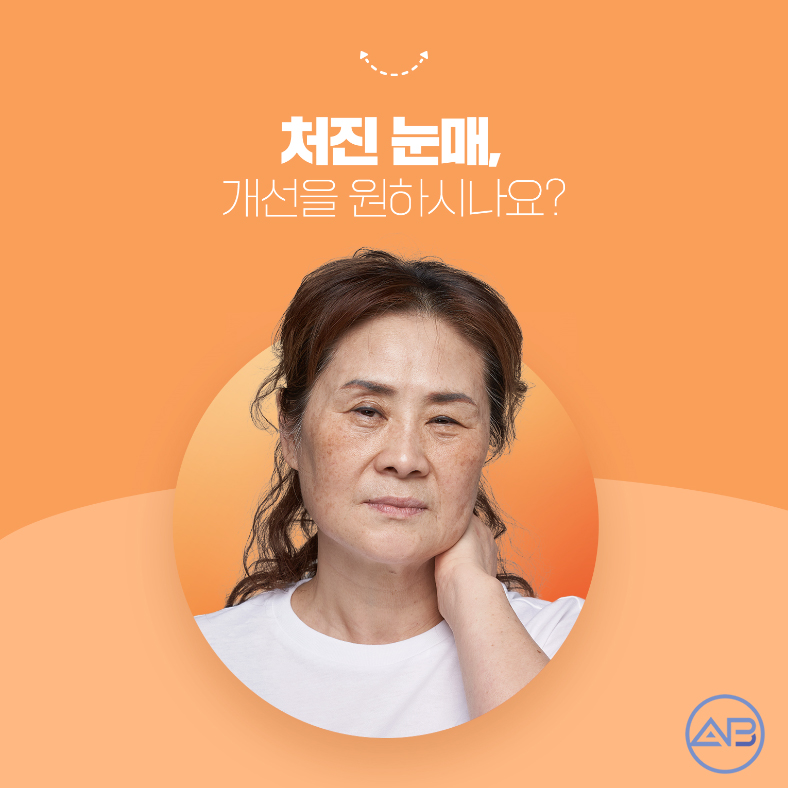에이비성형외과 "엄마는예뻤다 천안엄마" 상안검수술 중년눈성형의 꽃! 관련 이미지 1