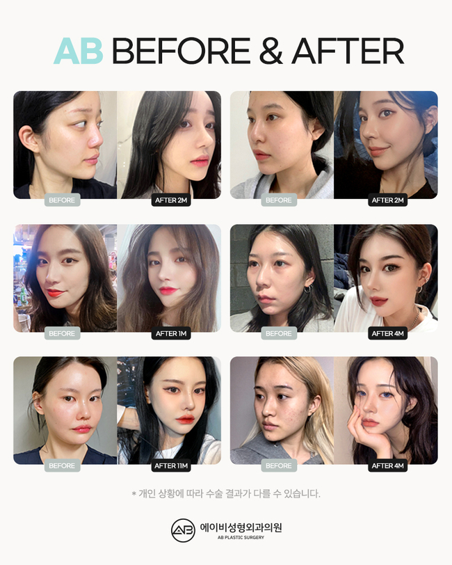AB Plastic Surgery’s Glamorous Nose Surgery POINT image 3