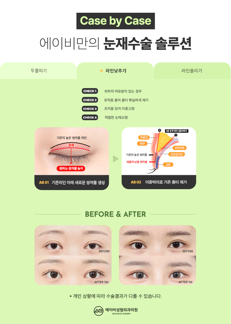 AB Revision Double Eyelid Surgery: What Is Double Folding? image 4
