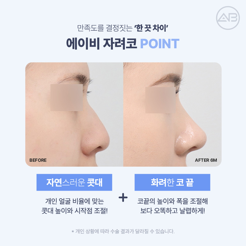 자려한코성형, 자연스럽고 세련된 코는 에이비성형외과 관련 이미지 3