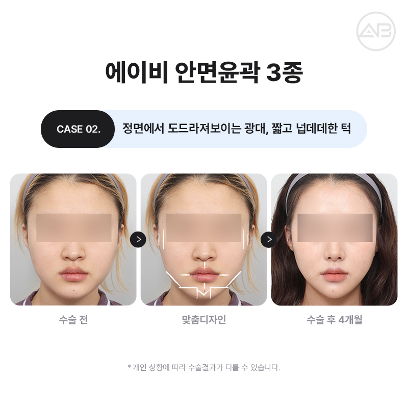 자연스럽고 조화로운 자려한안면윤곽을 원한다면 AB성형외과 관련 이미지 3
