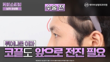#에이비성형외과#에이비tv#케이스리뷰#남자코성형 관련 이미지 3