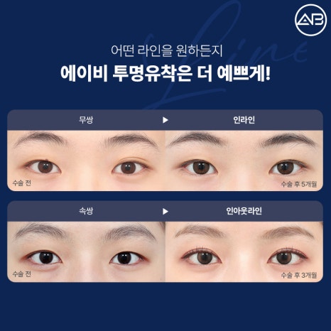 처음부터 예뻤던 것처럼, 에이비성형외과 자려한투명유착 관련 이미지 3