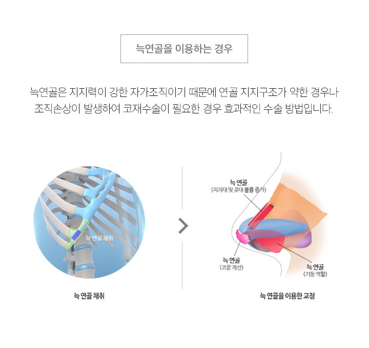 무보형물코수술잘하는곳 에이비성형외과는 어때? 관련 이미지 6