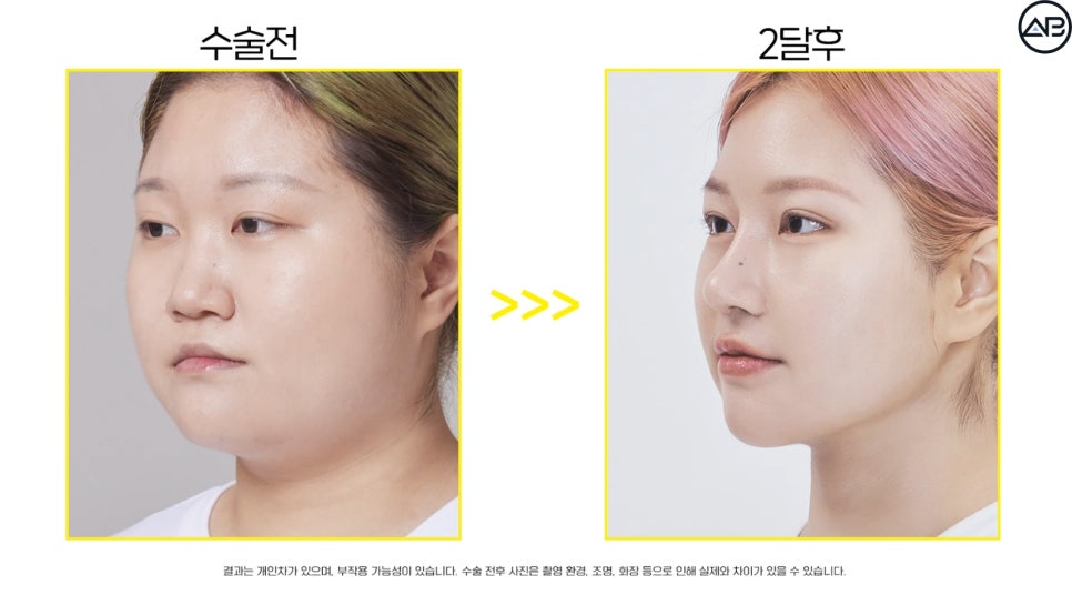 에이비성형외과 관련 이미지 20
