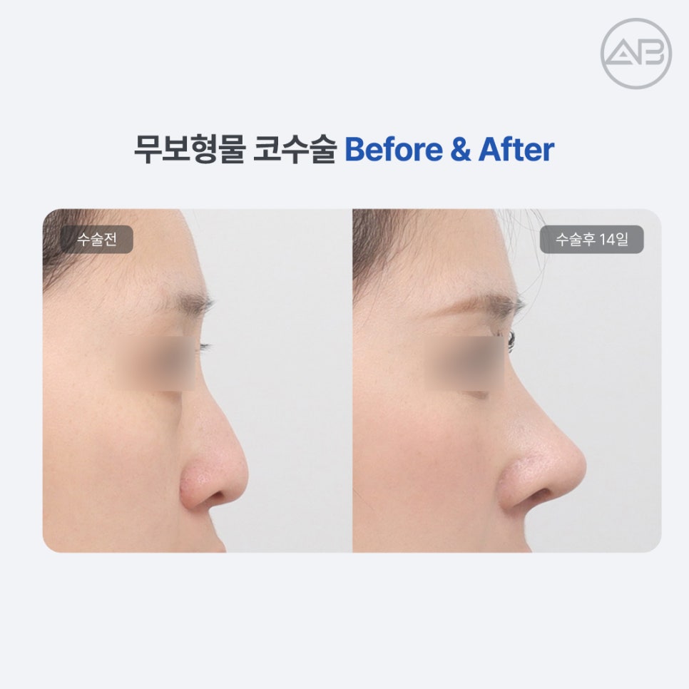 AB Plastic Surgery: Understanding Rhinoplasty Side Effects, Including Contracture, in Implant-Free Rhinoplasty image 3