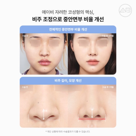 자려한비주라인코성형 AB성형외과에서 완성해보세요 관련 이미지 8