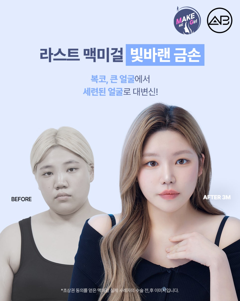 맥미걸 (MAKEMEGirl) 빛바랜금손, 자연스럽게 개선한 복코성형 리얼 후기 관련 이미지 7