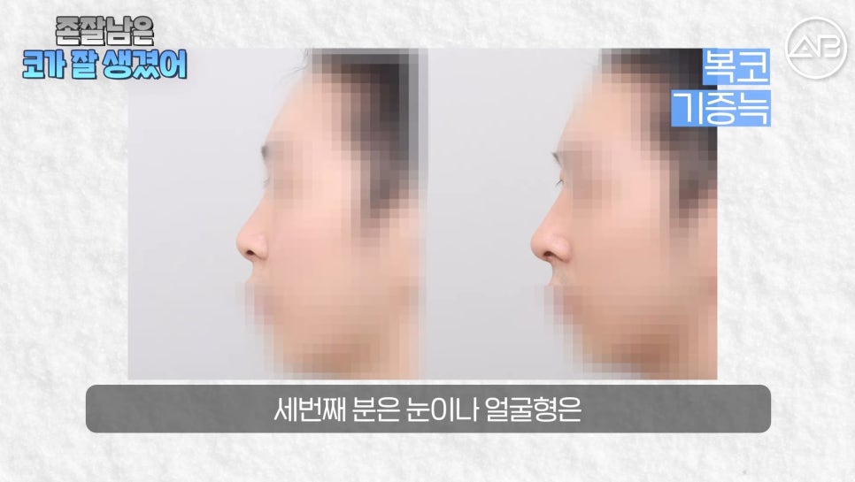 #AB Plastic Surgery #AB TV #Male Nose Surgery #Nose Surgery image 12