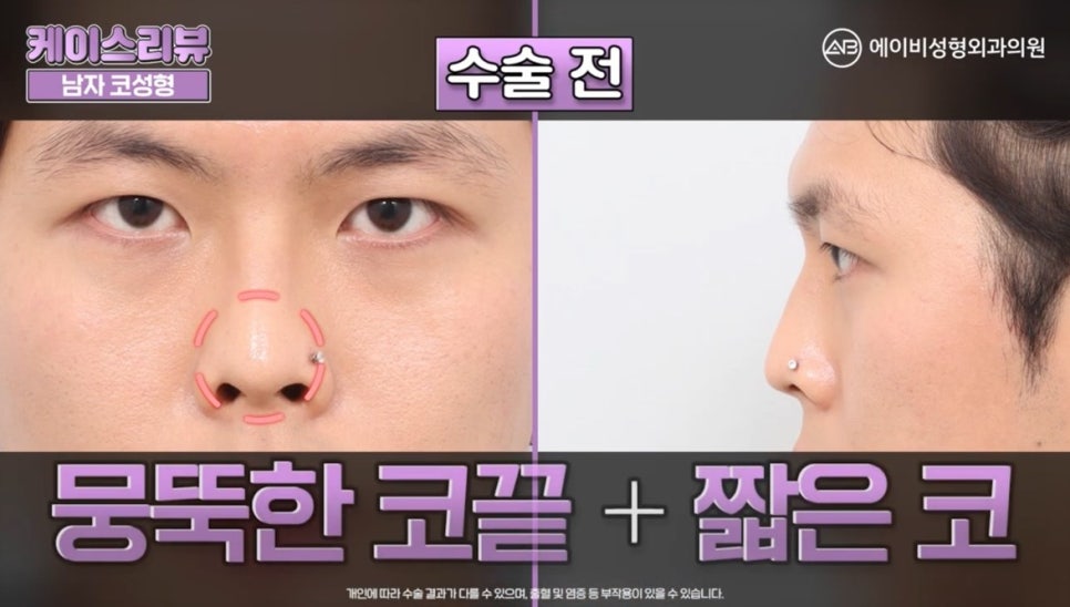 #에이비성형외과#에이비tv#케이스리뷰#남자코성형 관련 이미지 1