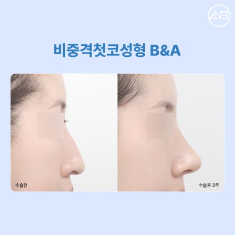 에이비성형외과 비중격첫코성형 꼭 늑연골이 필요할까? 비중격 귀연골 코성형 Q&A 관련 이미지 6