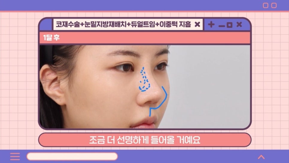 #AB Plastic Surgery #AB TV ##Case Review #Eye Surgery #Nose Revision Surgery image 8